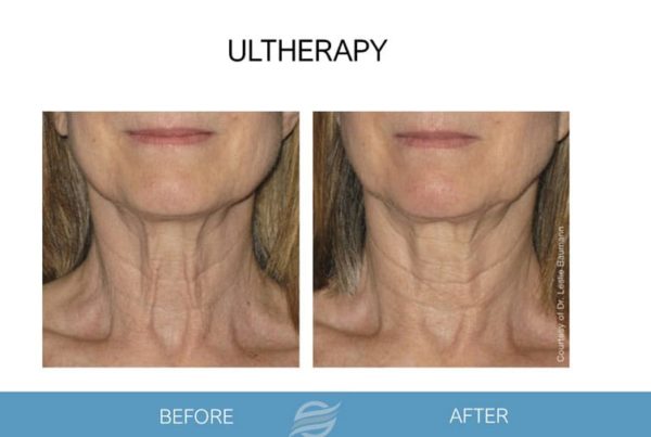 before and after ultherapy