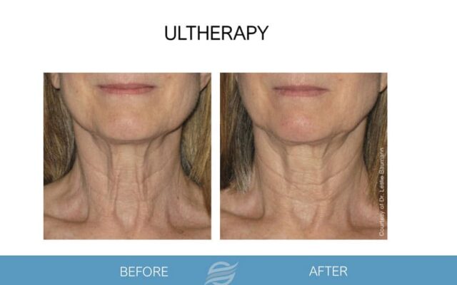 before and after ultherapy