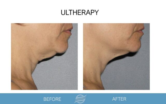 before and after ultherapy