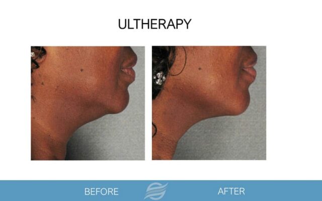 before and after ultherapy