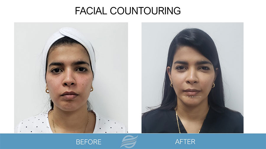 before and after facial contouring