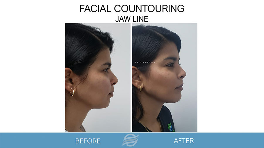 before and after facial contouring