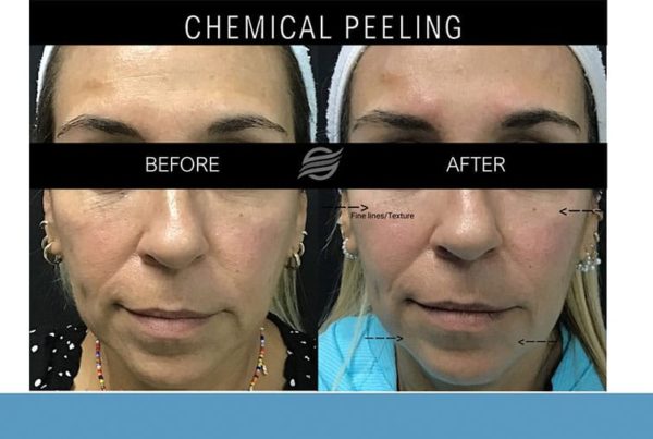 before and after chemical peel