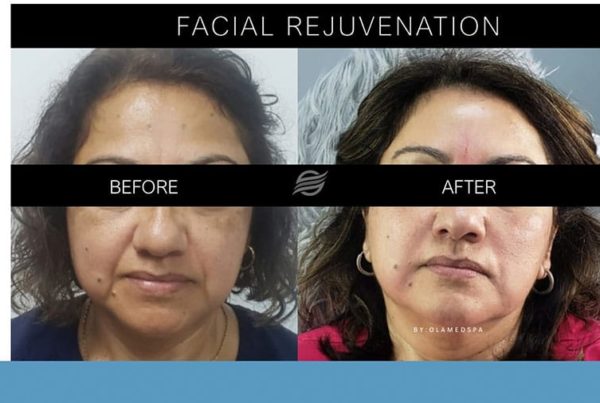 before and after facial rejuvenation