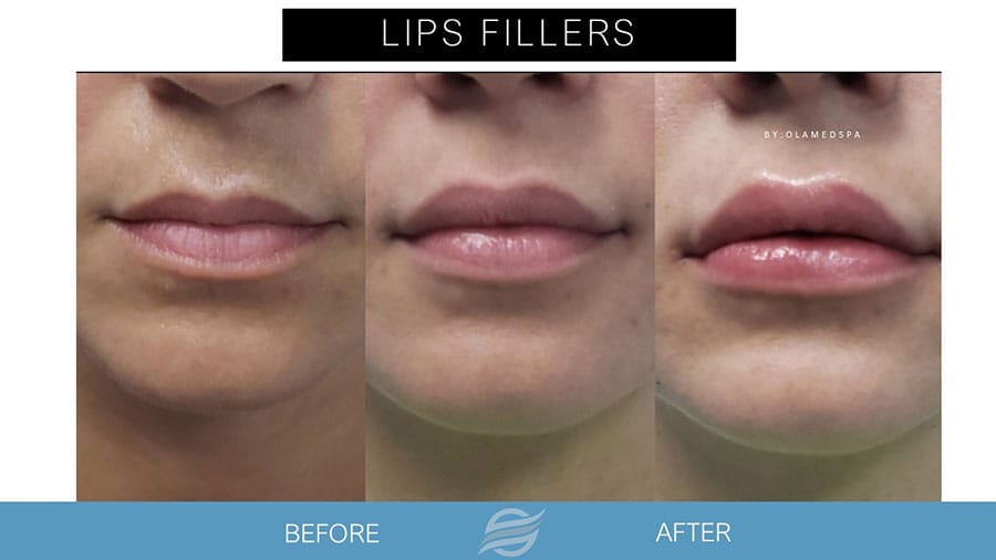 before and after lip filler