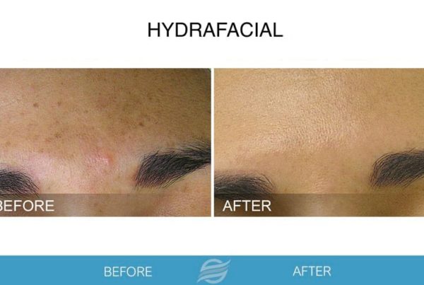 before and after hydrafacial in pembroke pines