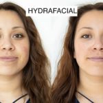 before and after hydrafacial