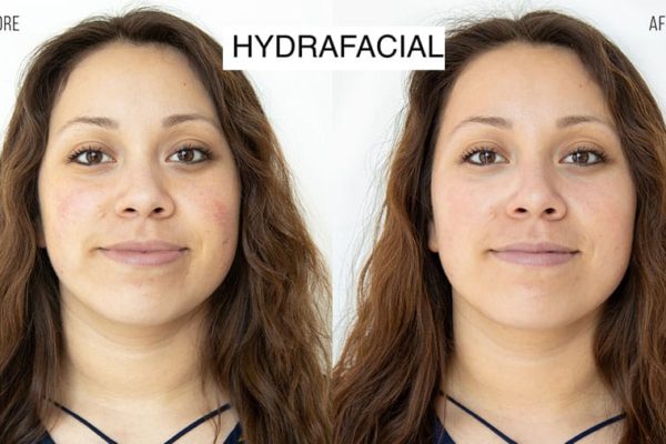 before and after hydrafacial