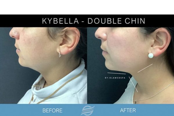 before and after kybella