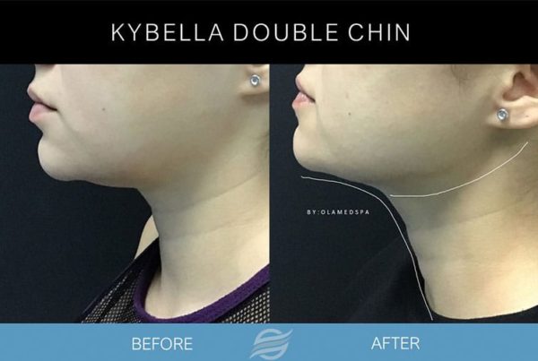 before and after kybella