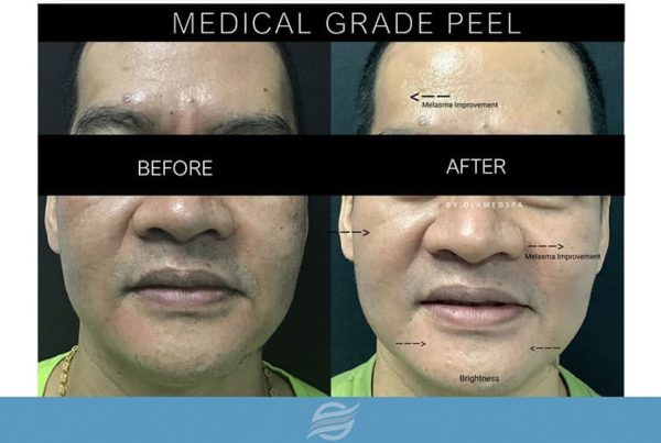 before and after medical grade peel