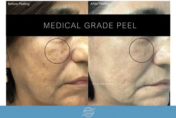 before and after medical grade peel