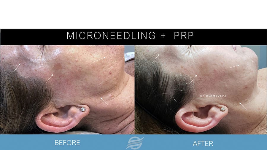 before and after mirconeedling and prp