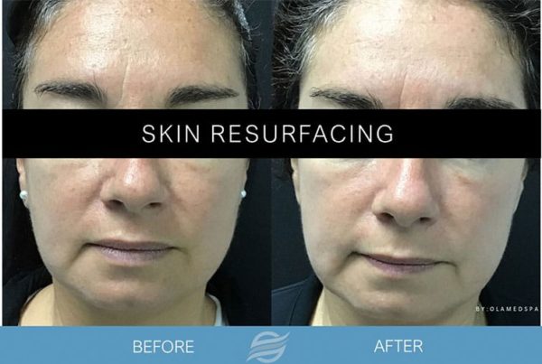 before and after skin resurfacing