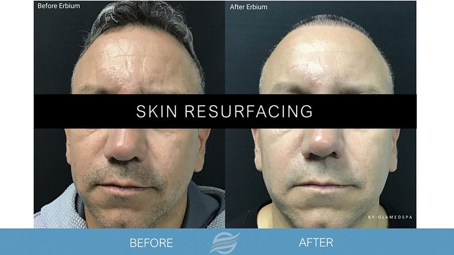 before and after skin resurfacing