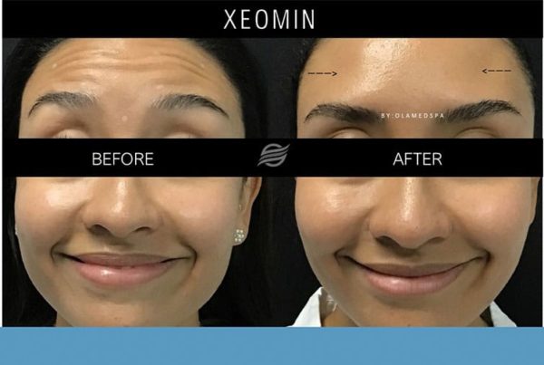 before and after xeomin