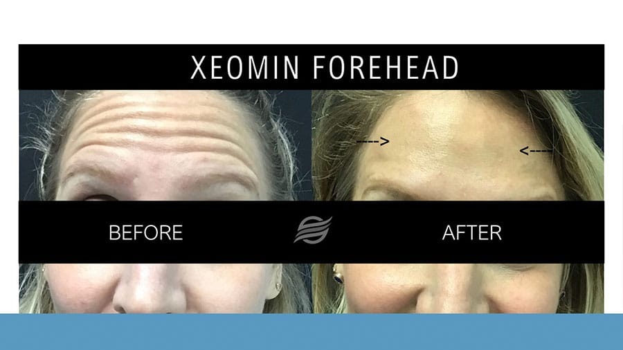 before and after xeomin