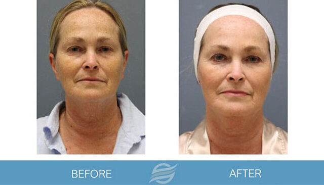 before and after microneedling pembroke pines