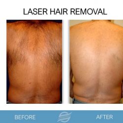 before and after laser hair removal