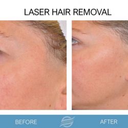 before and after laser hair removal