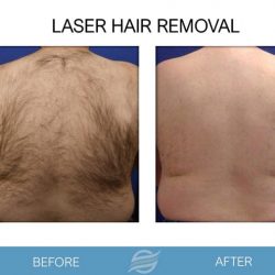 before and after laser hair removal