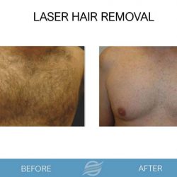 before and after laser hair removal