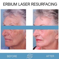 before and after laser resurfacing