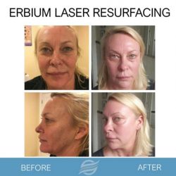 before and after laser resurfacing