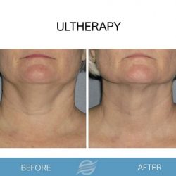 before and after ultherapy