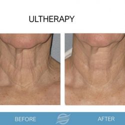 before and after ultherapy