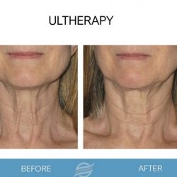 before and after ultherapy