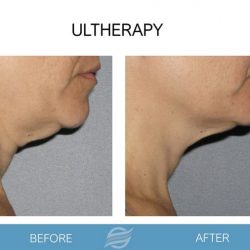 before and after ultherapy