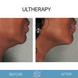 before and after ultherapy