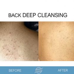 before and after back deep cleansing