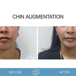 before and after chin augmentation