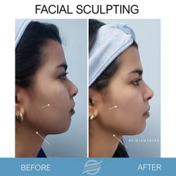 before and after facial sculpting