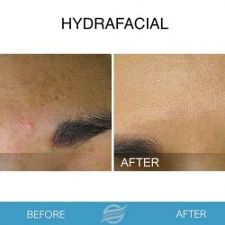 before and after hydrafacial in pembroke pines