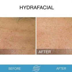 before and after hydrafacial in pembroke pines