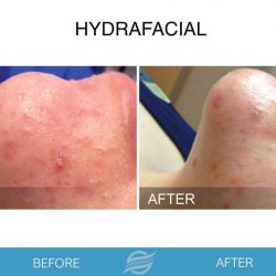 before and after hydrafacial in pembroke pines