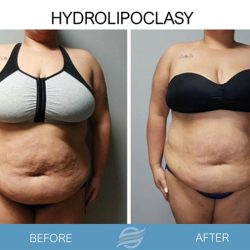 before and after hydrolipoclasy