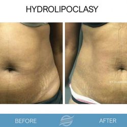 before and after hydrolipoclasy