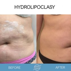 before and after hydrolipoclasy