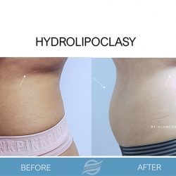 before and after hydrolipclasy