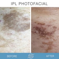 before and after ipl photofacial