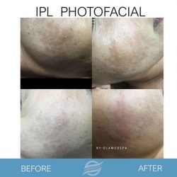 before and after ipl photofacial