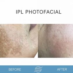 ipl-photofacial-03