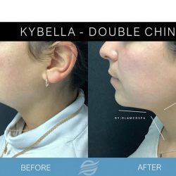 before and after kybella