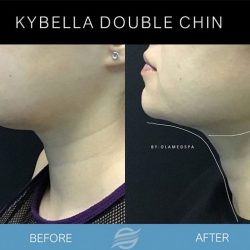 before and after kybella