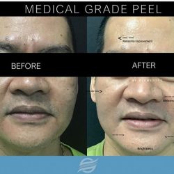 before and after medical grade peel