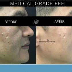 before and after medical grade peel